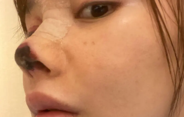 Cerita operasi hidung aktris Gao Liu viral pada 2020. Ujung hidungnya menghitam dan mati.