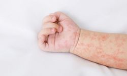 Tak Hanya Ruam, Campak Bisa Melemahkan Sistem Kekebalan Tubuh Anak dan Memicu Penyakit Lain