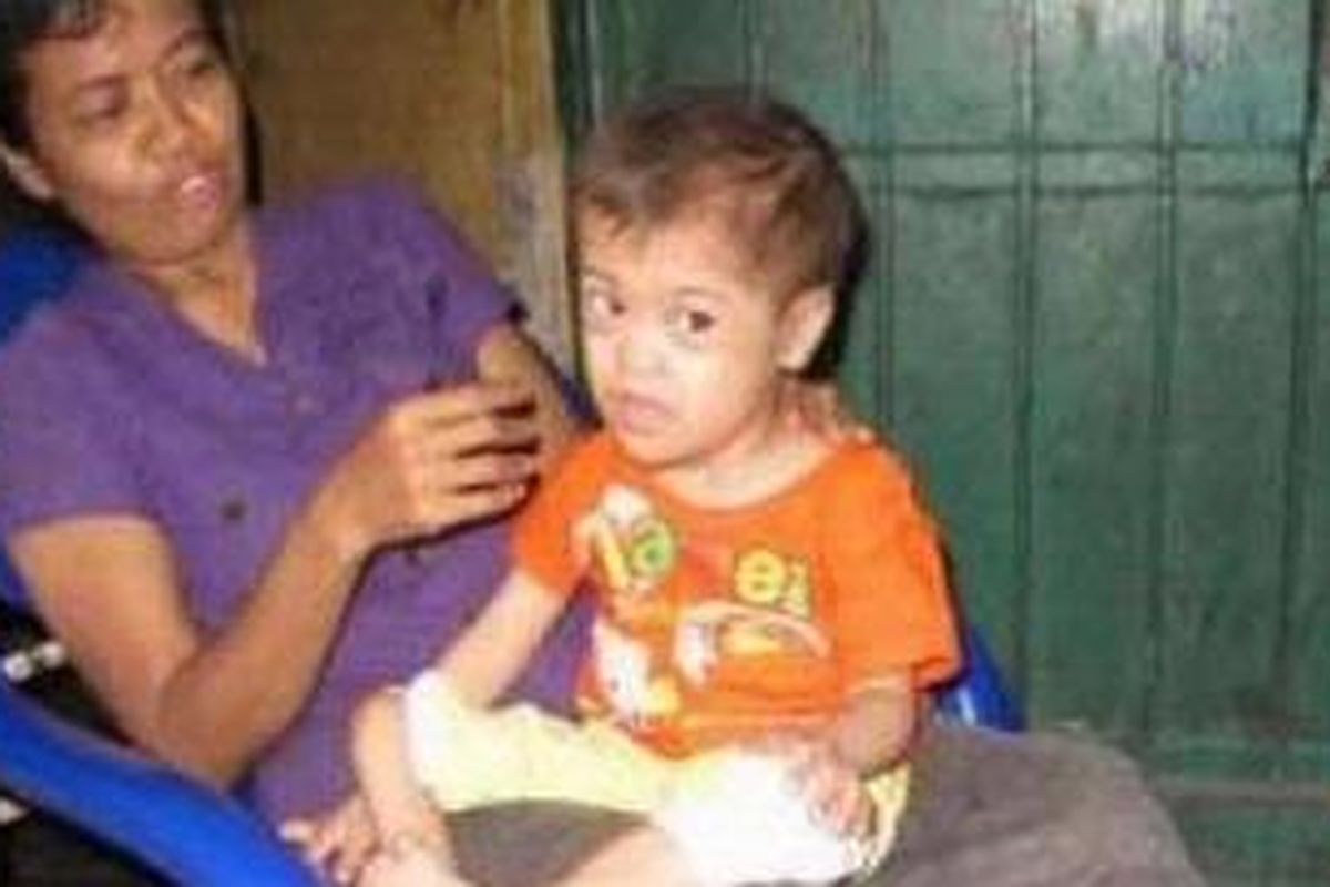 Irwansyah, usianya sudah 10 tahun, tetapi beratnya hanya 7 kg. Dia didiagnosa menderita sindrom down.