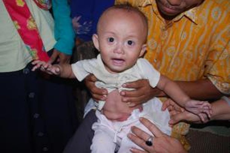M. Ilham, bayi pengidap penyakit Ileus akibat diberi makan bubur sejak usia 3 bulan.
