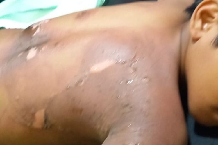 Seorang bocah SD di Kalangsari, Cipedes, Kota Tasikmalaya, Jawa Barat, terbakar tubuhnya saat bermain layang-layang dan masuk IGD RS Jasa Kartini Kota Tasikmalaya, Selasa (29/8/2023).
