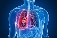 6 Mitos tentang Risiko Kanker Paru-paru, Jangan Lagi Percaya
