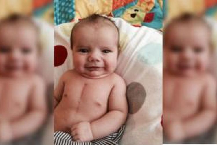 Bayi Aiden Rodgers yang terlahir dengan kelainan jantung bawaan. 