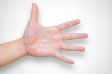 Penyebab Telapak Tangan dan Kaki Berkeringat Serta Cara Mengatasinya