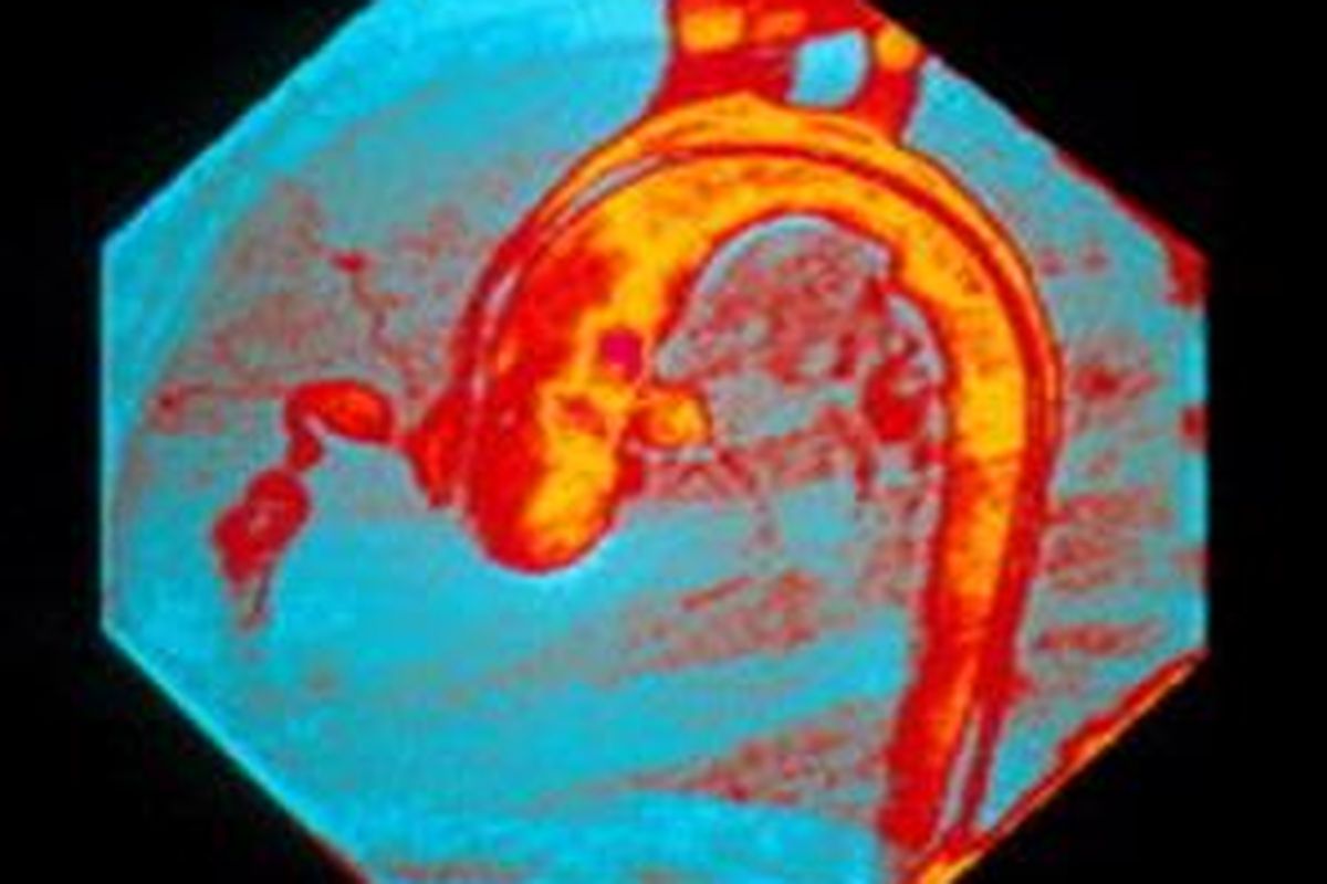 Penyakit Kawasaki. Angiogram (X-ray) berwarna dari arteri koroner abnormal seorang anak yang menderita penyakit Kawasaki. Aorta arteri yagn besar(kuning) membentuk sebuah putaran yang tampak di akhir dan pusat arteri jantung. 