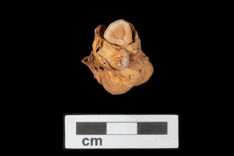 Arkeolog menemukan tumor ovarium yang sangat langka dengan gigi di pemakaman Mesir kuno.