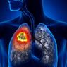 Mengenali Gejala Kanker Paru di Stadium Awal
