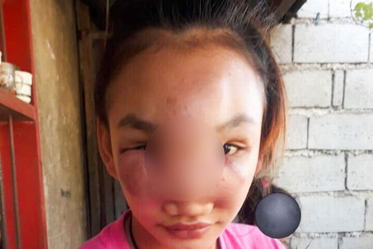 Mary Ann Regacho (17) gadis asal Filipina yang wajahnya membengkak sampai menutupi penglihatannya, yang berawal dari memencet sejenis jerawat.