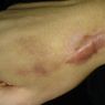 6 Cara Menghilangkan Keloid yang Dapat Dipertimbangkan