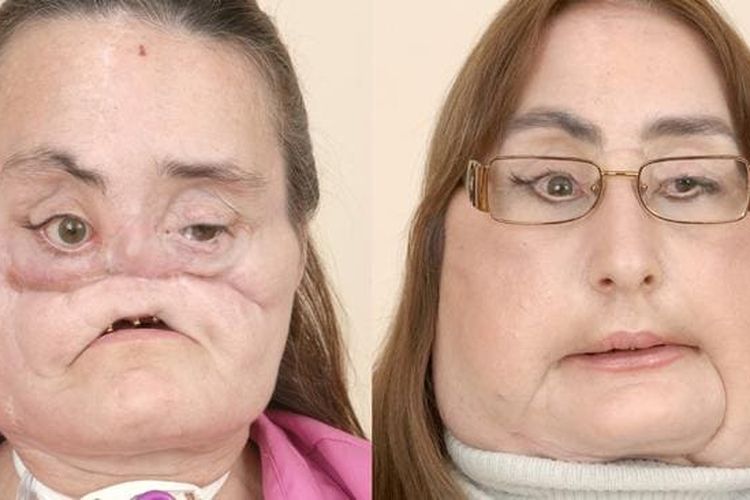 Wajah Culp rusak parah setelah insiden tragis (kiri), sebelum menjalani operasi transplantasi wajah pertama pada Desember 2008.