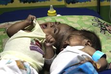 Nasib Kembar Siam Dempet Kepala Fadli-Fadlan, Kini Menderita Infeksi Saluran Udara