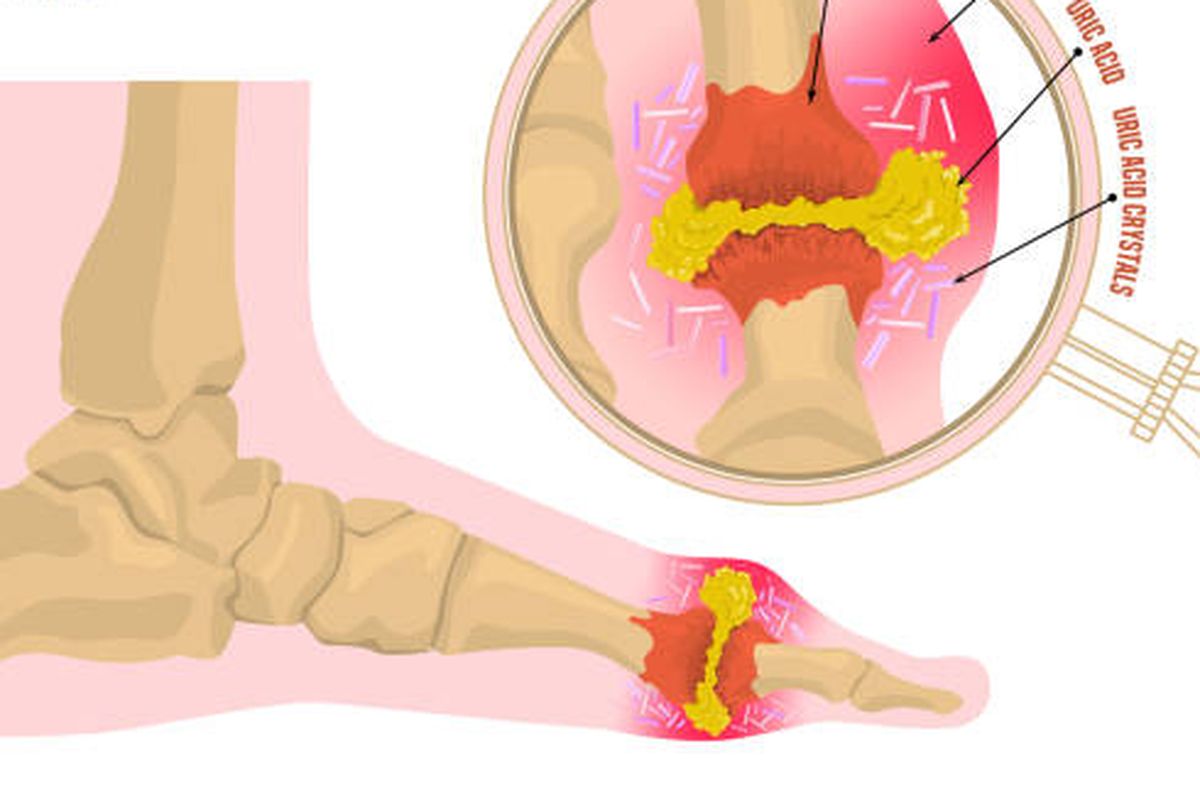Ilustrasi bengkak asam urat, cara menghilangkan bengkak asam urat