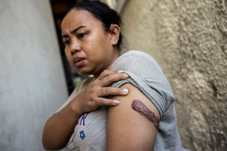 Dalam file foto yang diambil pada 7 Oktober 2022 ini, perempuan Indonesia Kartika Puspitasari menunjukkan bekas luka di lengannya akibat cedera yang dialami oleh majikan sebelumnya, di Bethune House. Bethune House adalah tempat penampungan yang dioperasikan oleh kelompok advokasi pekerja migran (MFMW), di Hongkong. Puspitasari, yang dipukuli dan dibakar oleh mantan majikannya di Hong Kong, menyebabkan dia menderita sakit kronis, diberikan ganti rugi lebih dari 110.000 dollar AS pada tanggal 10 Februari 2023. Majikannya dinyatakan bersalah dan dipenjara pada tahun 2013, dengan sidang pengadilan bagaimana mereka mengobarkan kampanye kekerasan dan penghinaan selama dua tahun terhadapnya. 