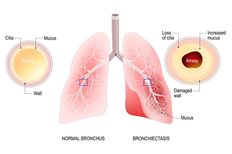 Ilustrasi Bronkiektasis