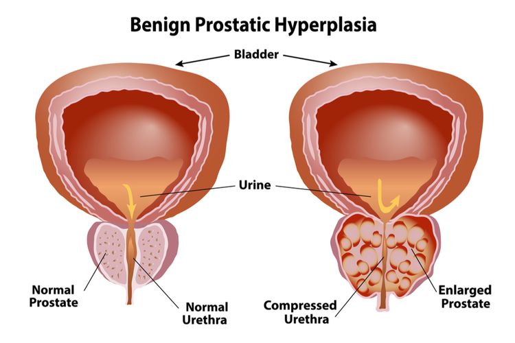 Ilustrasi Benign Prostatic Hyperplasia