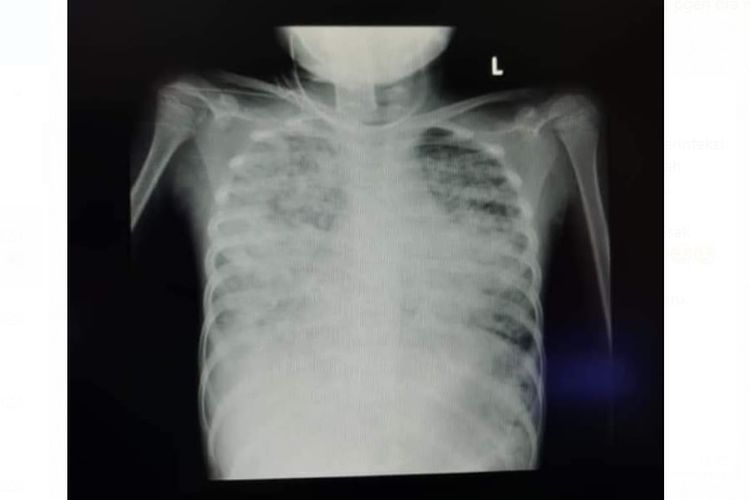 Tangkapan layar kondisi paru-paru diduga milik seorang pasien anak berusia 7 tahun yang positif virus corona. Paru-paru kiri dan kanan disebut telah dipenuhi cairan akibat virus.