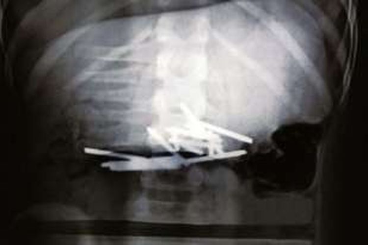 Hasil foto rontgen memperlihatkan paku-paku baja itu ada di dalam perut Xiao Wen, bocah berusia 10 tahun.