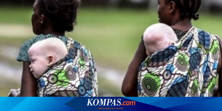 Ramai soal Bocah Albino di Wonogiri, Apa Penyebabnya dan Bisakah Disembuhkan?