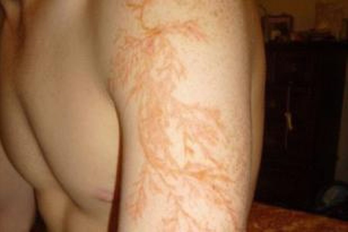 Pola miriup urat daun pada lengan Winston Kemp yang tersambar petir pada tahun 2011.
