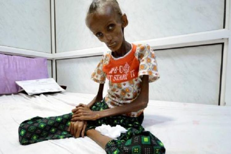 Saida Ahmad Baghili (18) duduk di tempat tidurnya di Rumah Sakit al-Thawra, Houdieda, kota pelabuhan Laut Merah, Yaman. Foto diambil pada 24 Oktober 2016. 