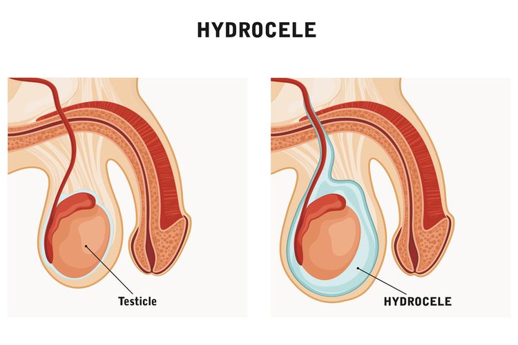 Ilustrasi hidrokel