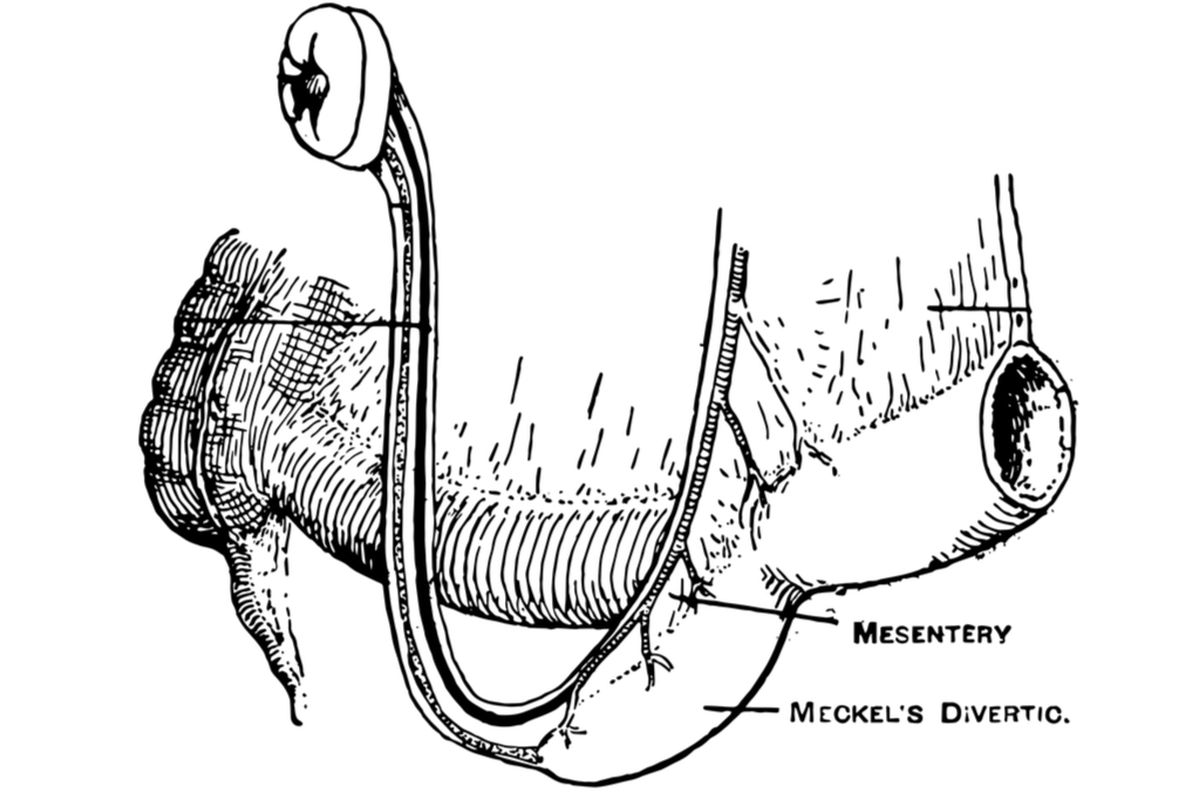 Ilustrasi Meckel Diverticulum