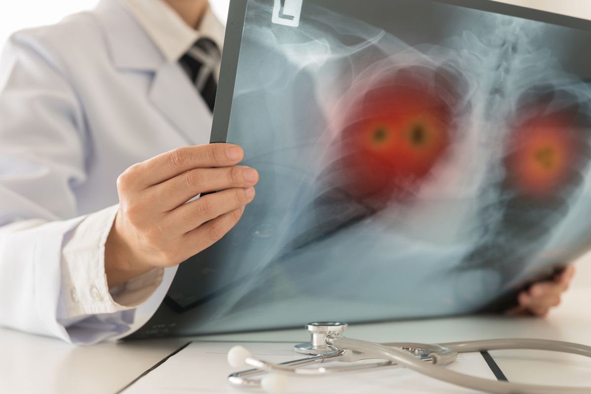 Ilustrasi CT scan paru-paru, kerusakan paru-paru akibat Covid-19. Infeksi virus corona merusak paru-paru pasien Covid-19. Transplantasi paru-paru atau cangkok paru-paru menjadi satu-satunya harapan hidup pasien setelah sembuh dari Covid-19.