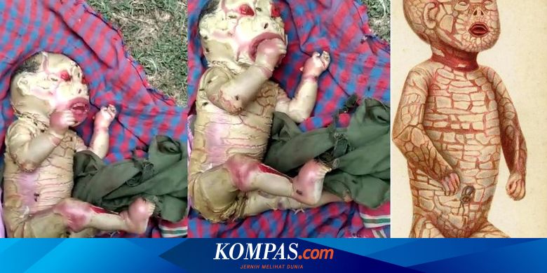 Hoaks Video Bayi Aneh Di India Nama Kondisinya Harlequin