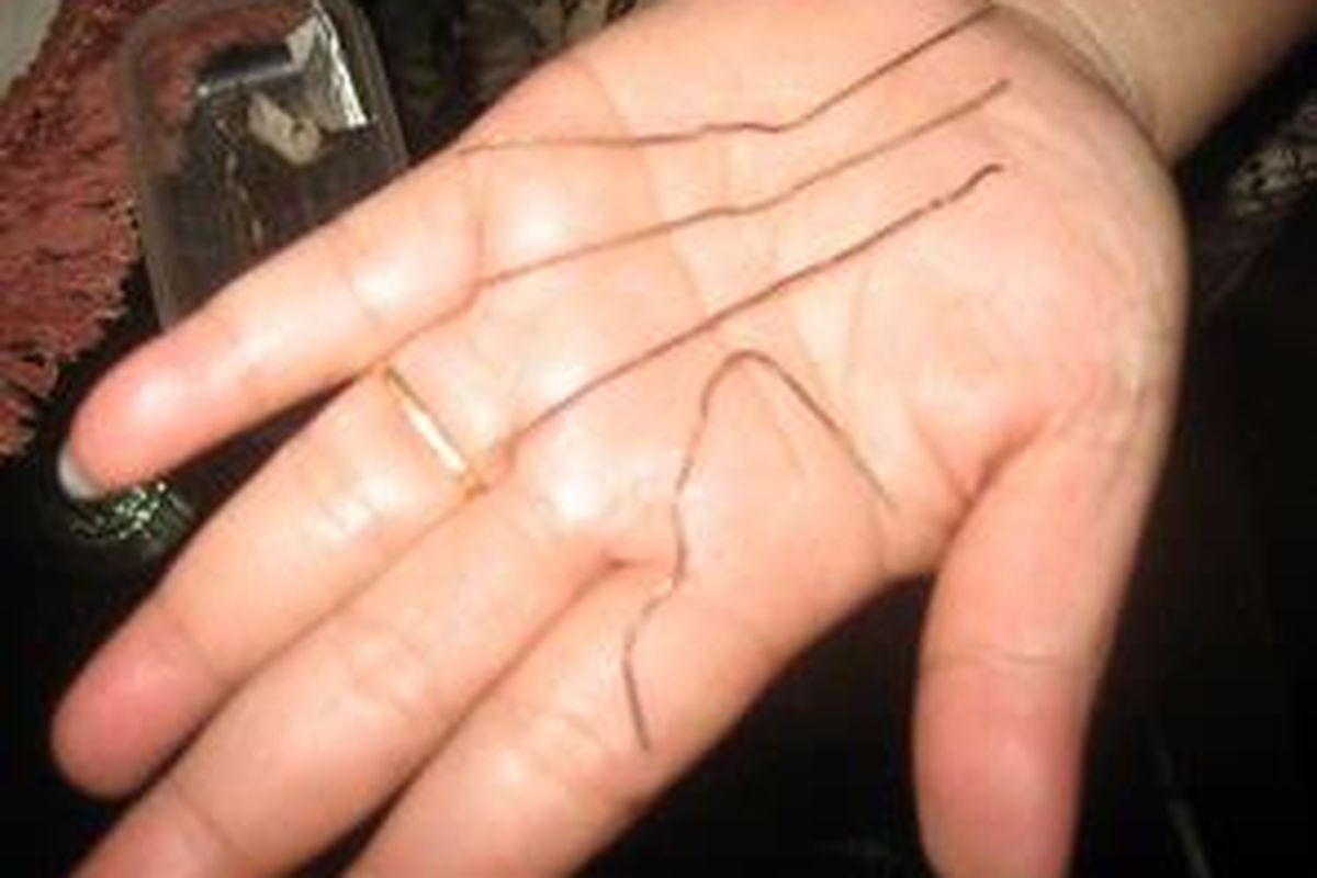 Noorsyaidah menunjukkan beberapa potongan kawat yang berhasil dikeluarkan dari perutnya kepada fotografer Tribun Kaltim