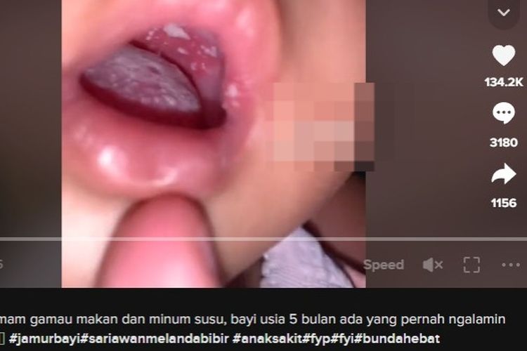 Ramai soal bintik putih pada mulut.