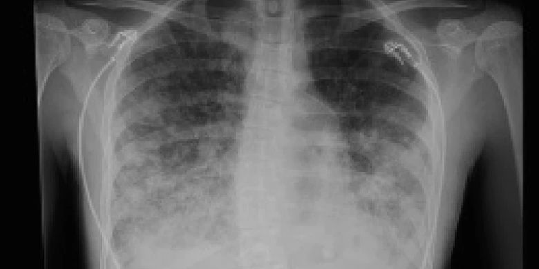 Dari hasil pengamatan dokter, paru-paru Dakota kemungkinan besar mengalami EVALI yang disebabkan 'vaping'.