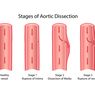 Diseksi Aorta