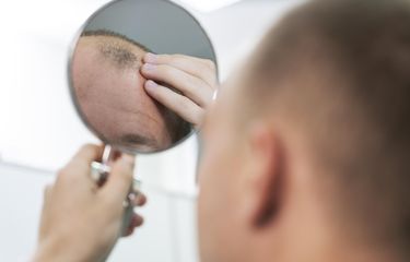 Ilustrasi rambut rontok.