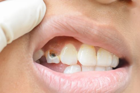 6 Cara Mencegah Penumpukan Plak Gigi yang Bisa Sebabkan Gigi Berlubang