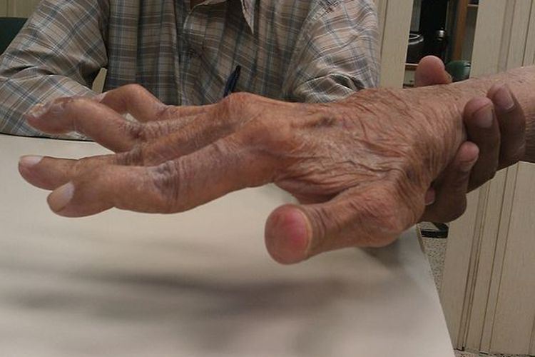 Ilustrasi rematik pada sendi jari tangan pasien berusia 65 tahun. Penyebab rematik belum diketahui pasti hingga saat ini.