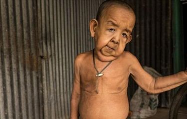 Bayezid Hossain berusia 4 tahun, tetapi terlihat seperti berusia 80 tahun karena penyakit langka progeria.