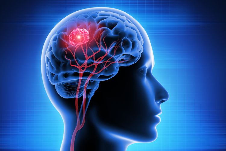 Ilustrasi tumor otak. Covid-19 sebabkan perubahan otak, kerusakan otak mulai dari kehilangan kemampuan indera penciuman, hingga masalah konsentrasi dan memori pada orang tua paruh baya hingga lansia.