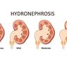 Hidronefrosis