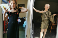 Stres karena Pandemi Covid-19, Gadis 8 Tahun Cabut Rambut sampai Nyaris Botak