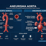 Bahaya Gangguan Aorta yang Kerap Tak Bergejala dan Cara Mencegahnya