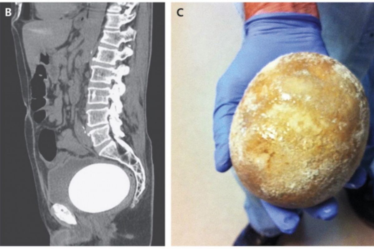 Batu seukuran telur burung unta tersebut (kiri) dikeluarkan dari kandung kemih pria berusia 64 tahun di California, AS.