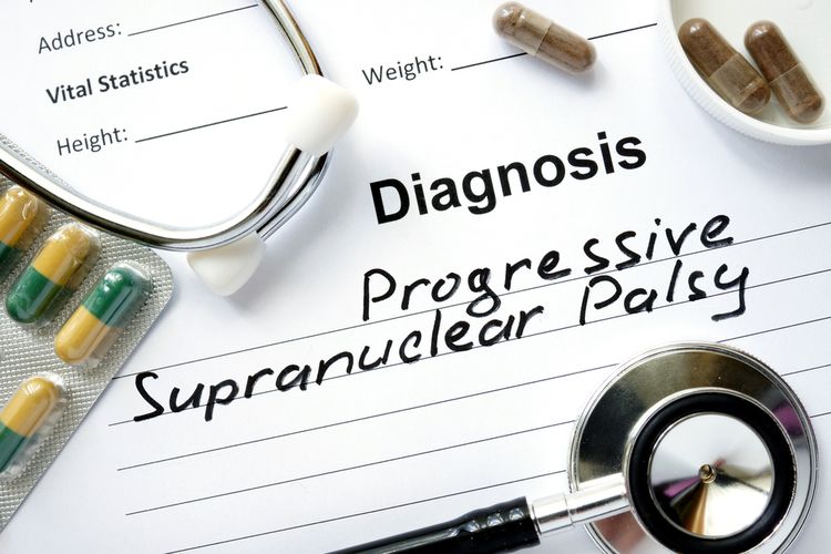 Ilustrasi progressive supranuclear palsy