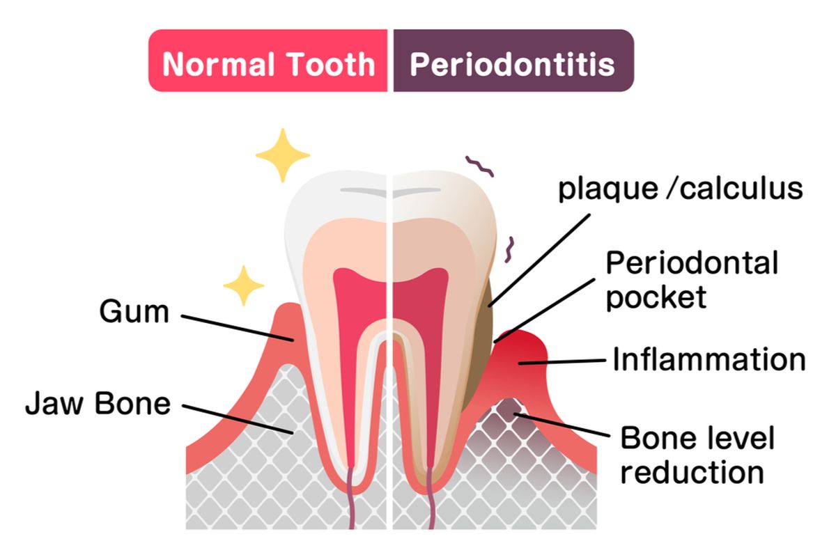 ilustrasi periodontitis