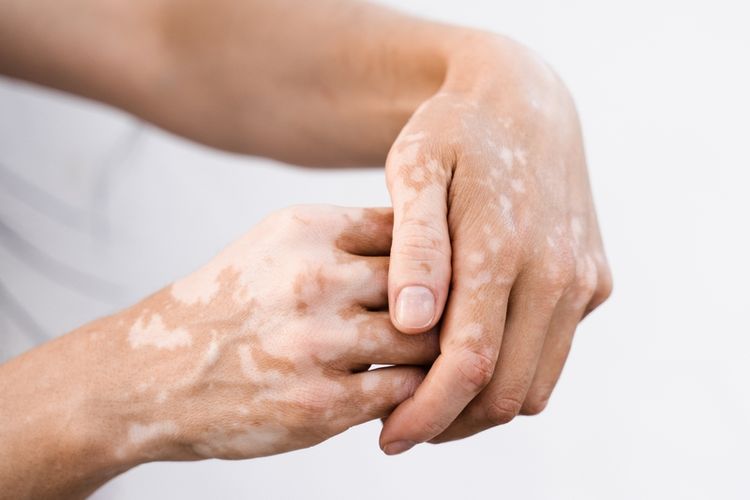 Ilustrasi penderita vitiligo