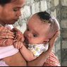 Derita Yohanes, Bayi di Manggarai Mengidap Hidrosefalus, Tak Punya Biaya Berobat ke RS