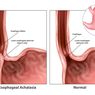 Akalasia
