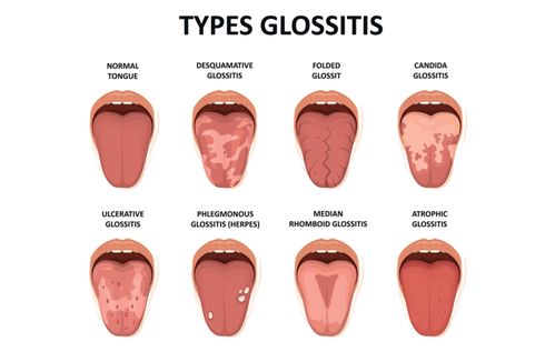 Glositis