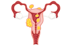 Mioma Uteri