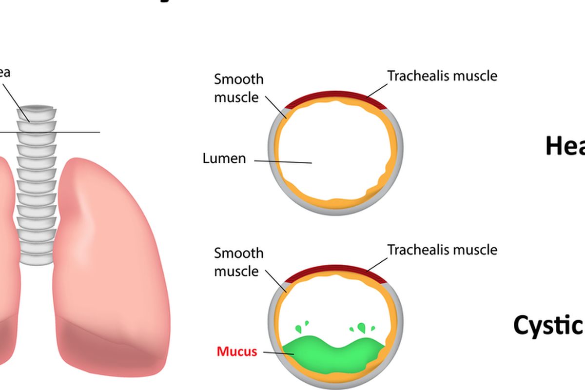 Ilustrasi Fibrosis Kistik
