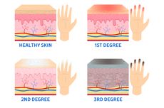 Kenali Apa Itu Frostbite, Penyebab, dan Tanda-tandanya